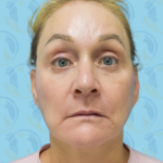 Facelift Before & After Patient #2943