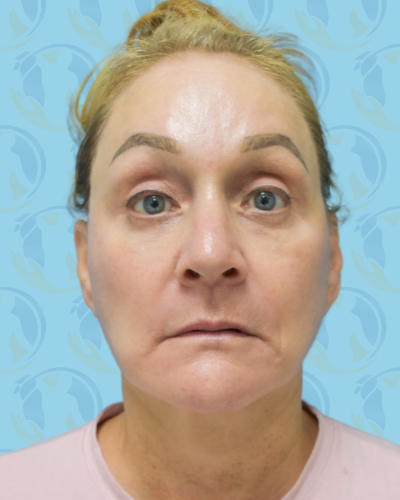 Facelift Before & After Patient #2943