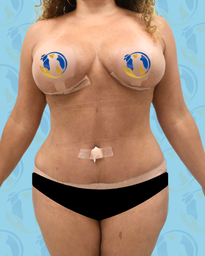 Mommy Makeover Before & After Patient #2960