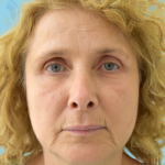 Facelift Before & After Patient #2944
