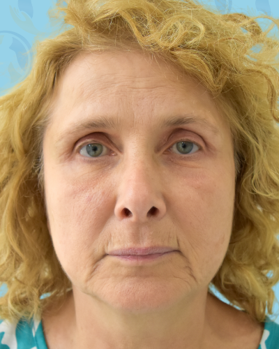 Facelift Before & After Patient #2944