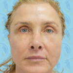 Facelift Before & After Patient #2944