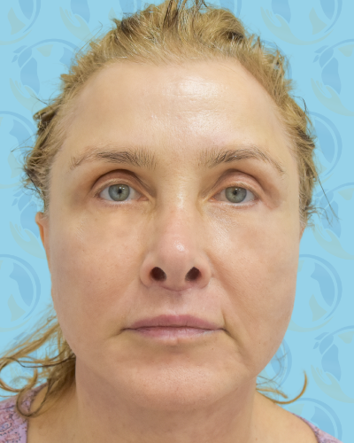 Facelift Before & After Patient #2944