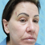 Facelift Before & After Patient #2947