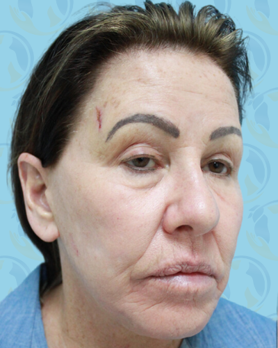 Facelift Before & After Patient #2947