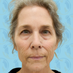 Facelift Before & After Patient #2949