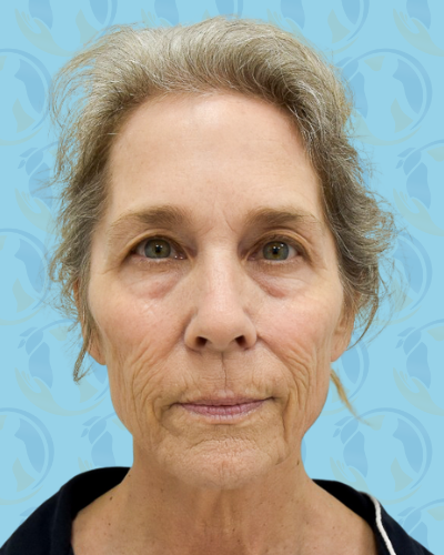 Facelift Before & After Patient #2949