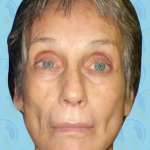 Facelift Before & After Patient #2951