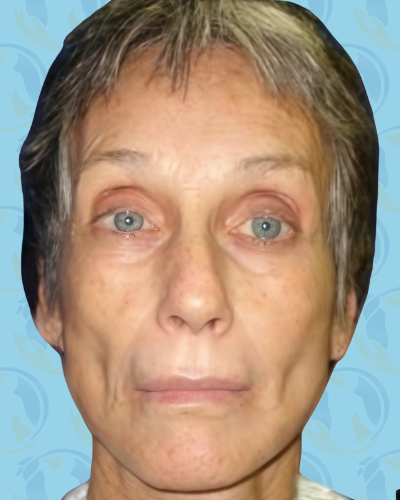 Facelift Before & After Patient #2951