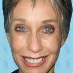 Facelift Before & After Patient #2951