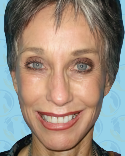 Facelift Before & After Patient #2951