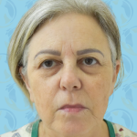 Facelift Before & After Patient #2952