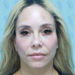 Facelift Before & After Patient #2955