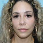 Facelift Before & After Patient #2955