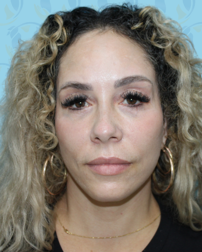 Facelift Before & After Patient #2955